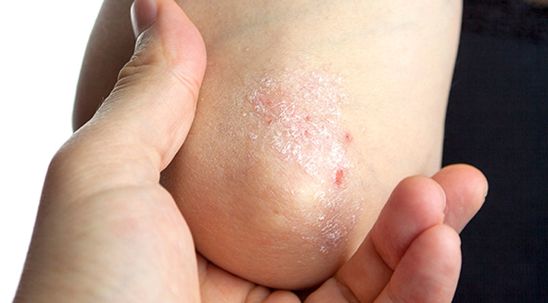 How To Manage Psoriasis